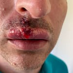 lip after biopsy