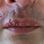 lip and upper lip with cysts still present