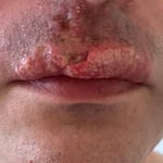 lip healed after biopsy
