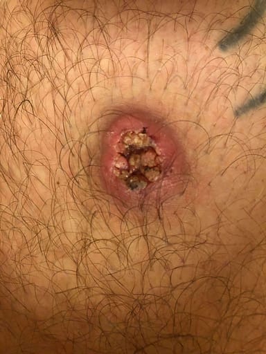 Squamous Cell Carcinoma on leg