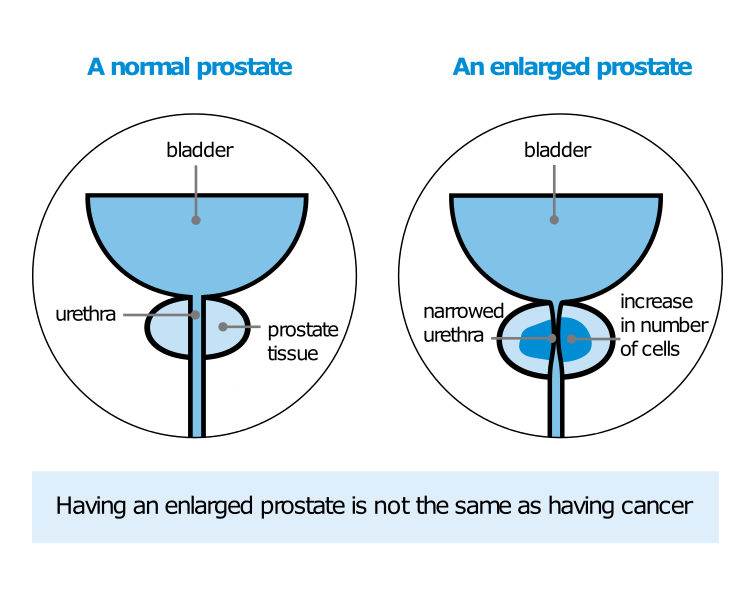 Enlarged Prostate Comparison