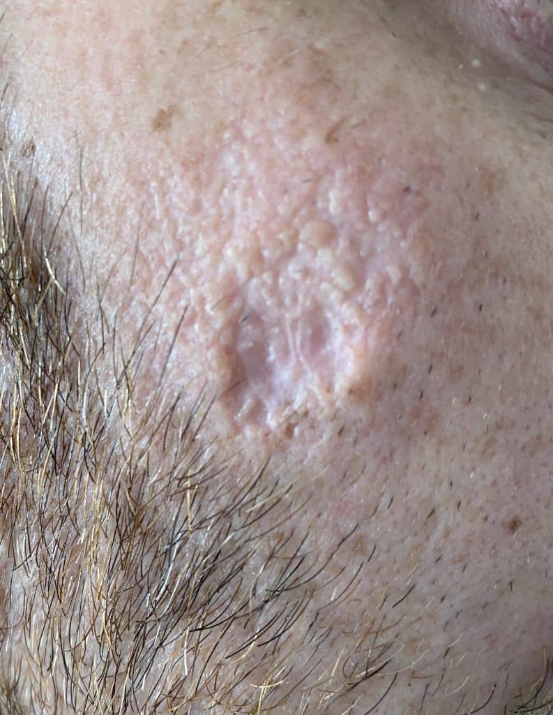 pitted scar from self healing squamous epithelioma