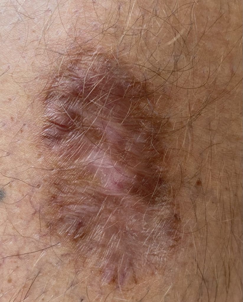 Scar from squamous cell carcinoma removal